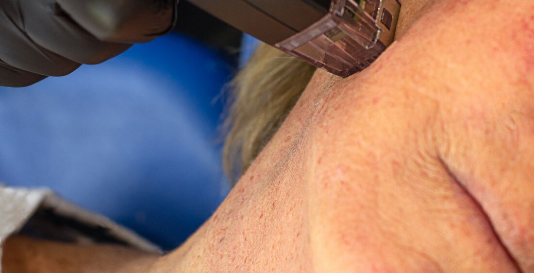 close up skin treatment. beautician treatment close up skin treatment. beautician treatment