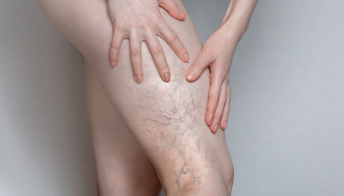 Woman shows leg with varicose veins. The concept of human health and disease.
