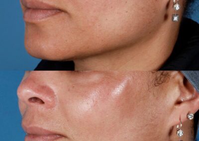 Chemical Peels