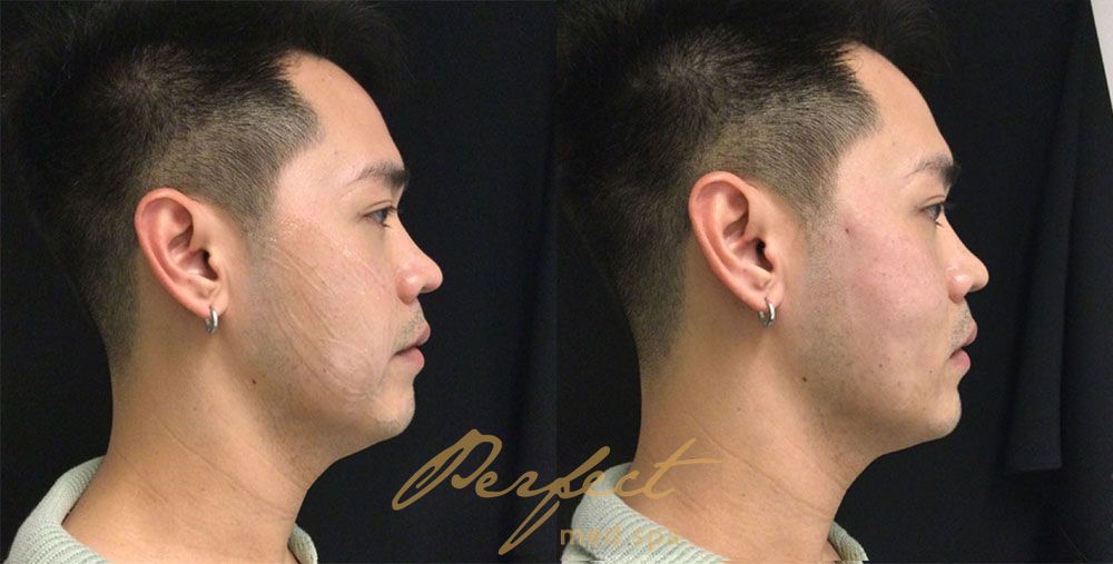 PDO Threads Before and After Photo by Perfect Med SPA in New York New York