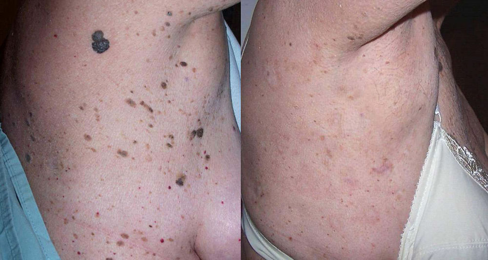 Mole Removal Before and After Photo by Perfect Med Spa in New York City, NY