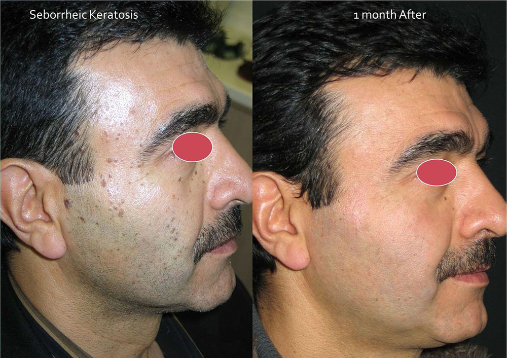 Mole Removal Before and After Photo by Perfect Med Spa in New York City, NY