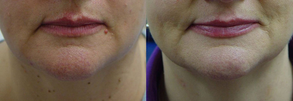 Mole Removal Before and After Photo by Perfect Med Spa in New York City, NY