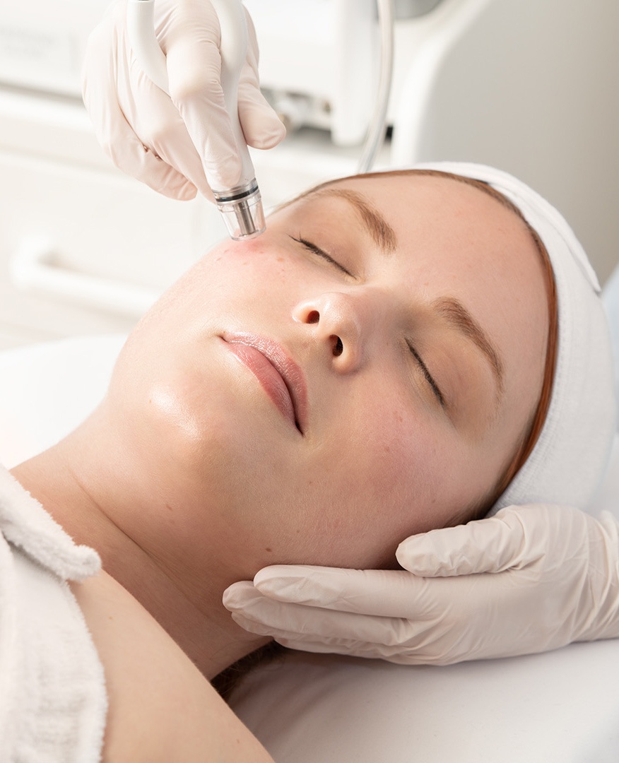 microneedling treatment performed on womans cheek microneedling treatment performed on womans cheek