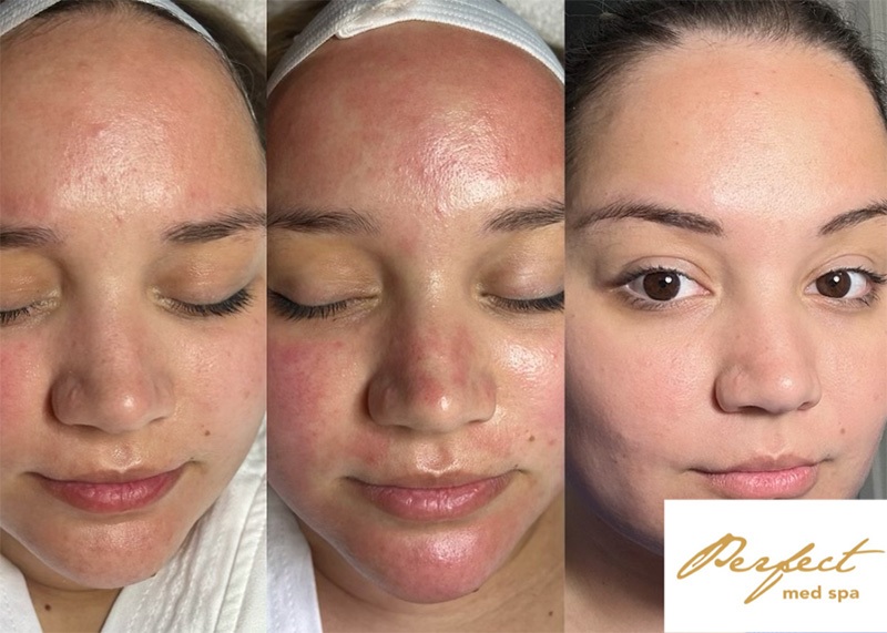 Microneedling