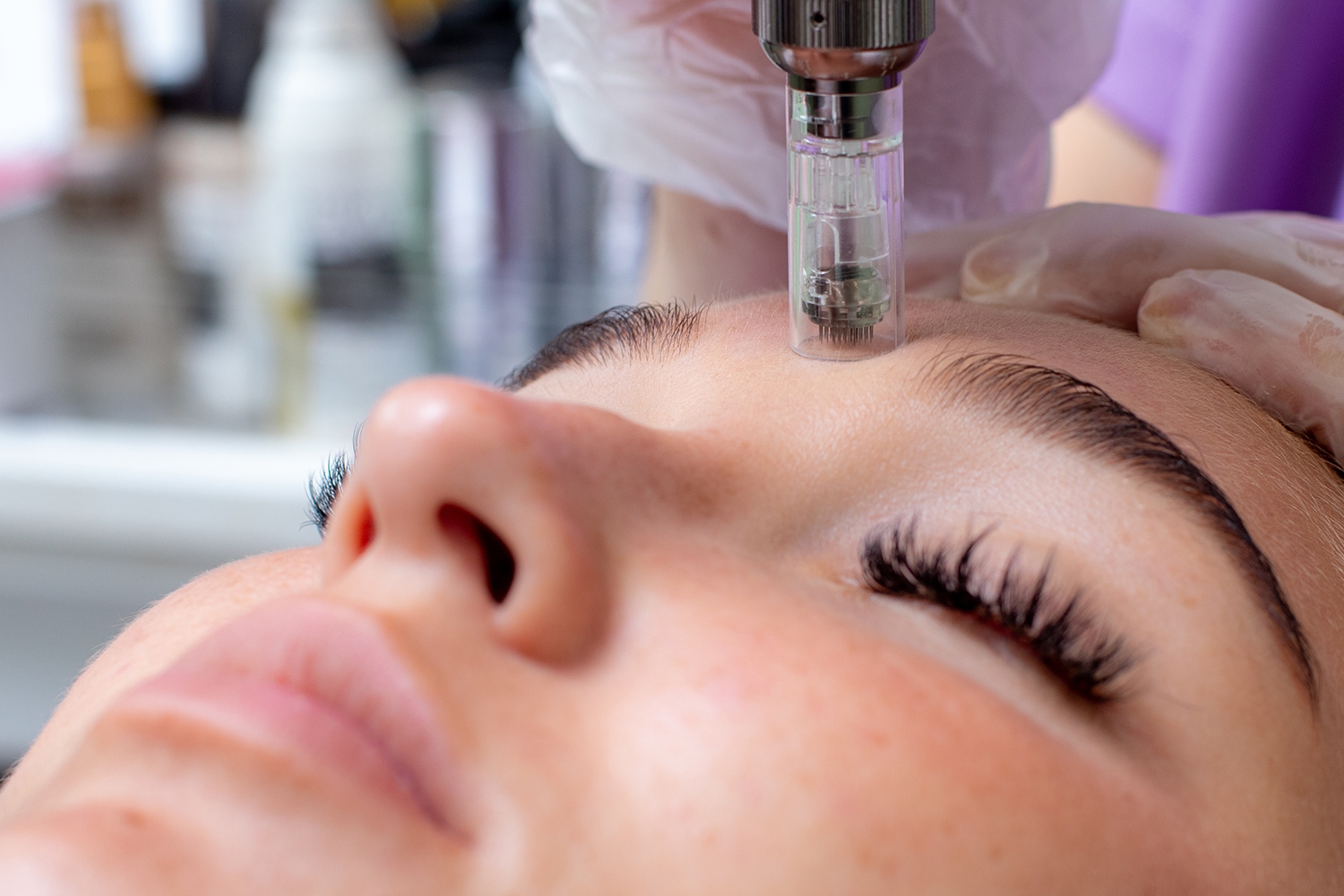 microneedle facial therapy close up microneedle facial therapy close up