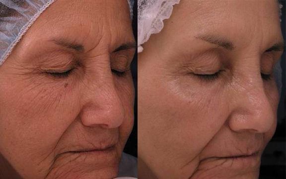 Fotona D Facelift Before and After Photo by Perfect Med Spa in New York City, NY