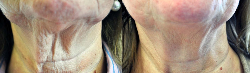 Fotona D Facelift Before and After Photo by Perfect Med Spa in New York City, NY