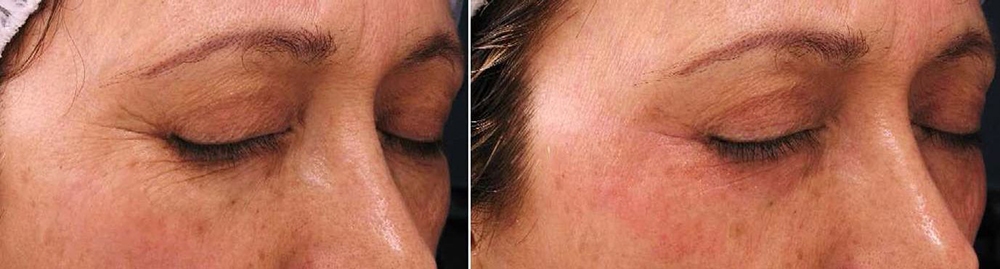 Fotona D Facelift Before and After Photo by Perfect Med Spa in New York City, NY