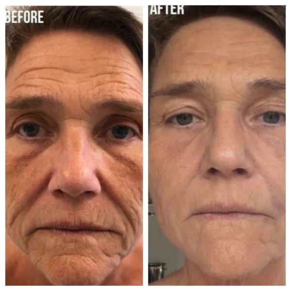 Fotona D Facelift Before and After Photo by Perfect Med Spa in New York City, NY