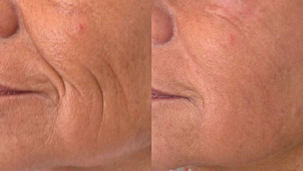 Fotona D Facelift Before and After Photo by Perfect Med Spa in New York City, NY