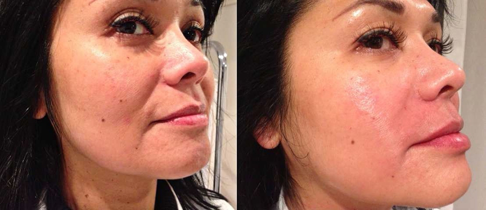 Fotona D Facelift Before and After Photo by Perfect Med Spa in New York City, NY