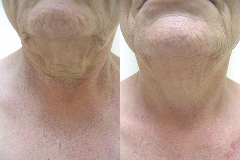 Fotona D Facelift Before and After Photo by Perfect Med Spa in New York City, NY