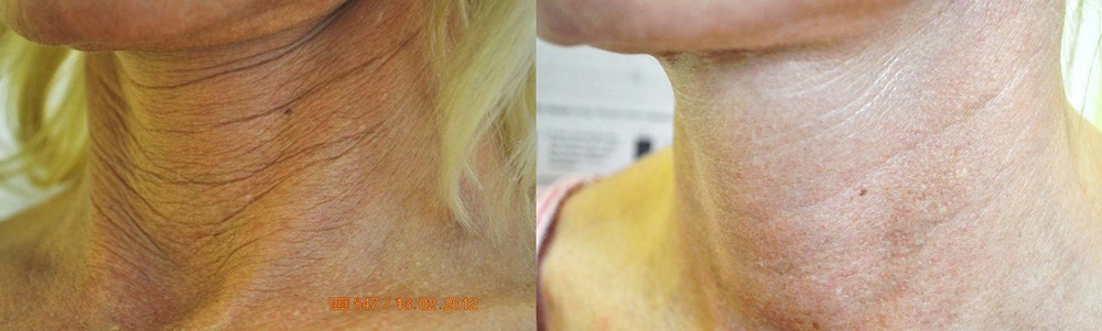 Fotona D Facelift Before and After Photo by Perfect Med Spa in New York City, NY