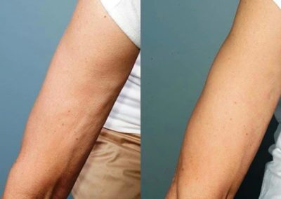 Tightsculpting