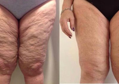 Tightsculpting