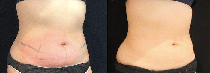 CoolSculpting Before and After Photo by Perfect Med Spa in New York City, NY