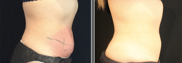 CoolSculpting Before and After Photo by Perfect Med Spa in New York City, NY