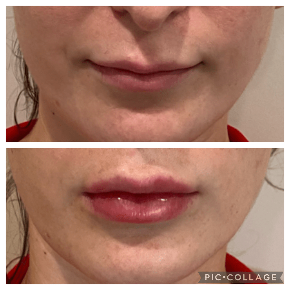 Lip Injections Facelift Before and After Photo by Perfect Med Spa in New York City, NY
