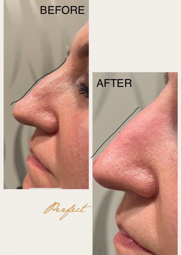Nose Filler Before and After Photo by Perfect Med Spa in New York City, NY