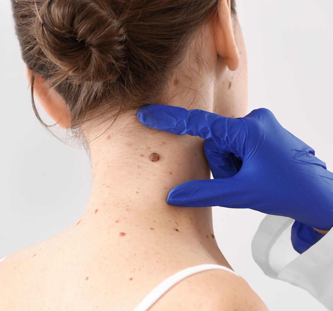 Dermatologist examining moles of patient on light background Dermatologist examining moles of patient on light background