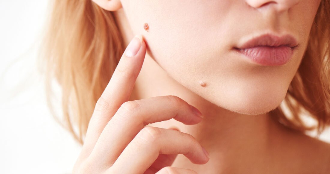 The mole on the girl's face closeup The mole on the girl's face closeup