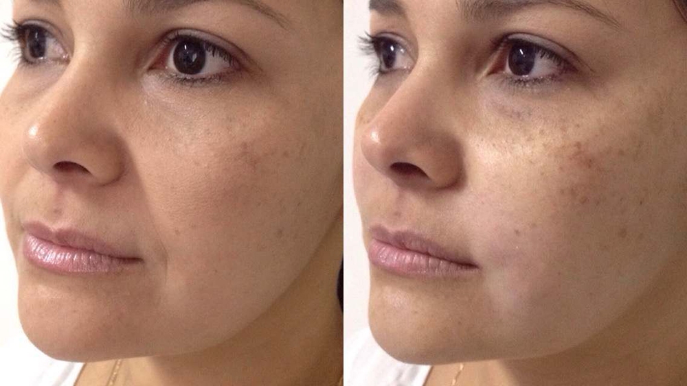 Fotona D Facelift Before and After Photo by Perfect Med Spa in New York City, NY