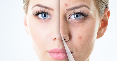 acne laser treatment blonde woman acne laser treatment blonde woman