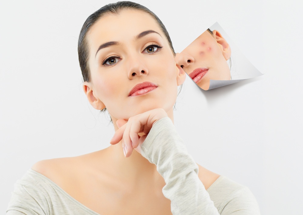 acne laser treatment model acne laser treatment model