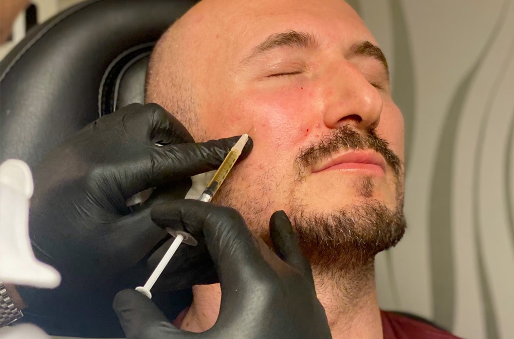 PRFM advanced prp rejuvenation male patient at Perfect MedSpa