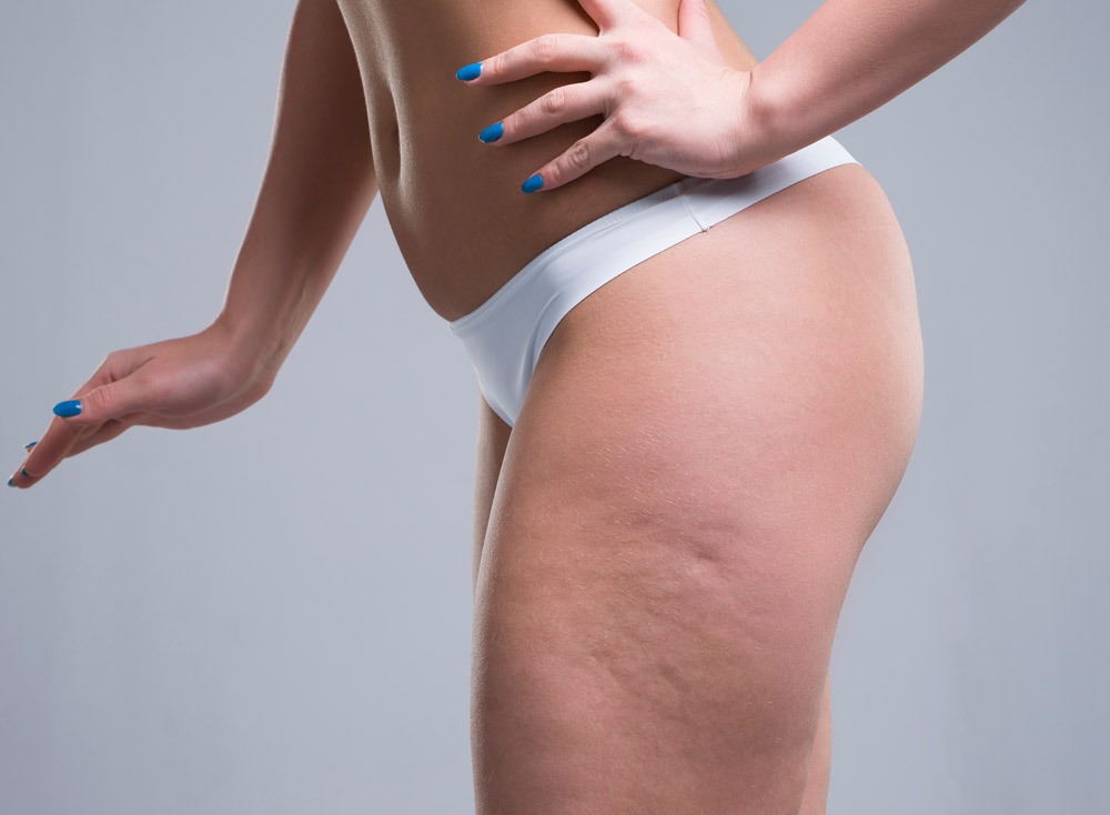 Woman in white underwear on gray background, cellulite on female body Woman in white underwear on gray background, cellulite on female body