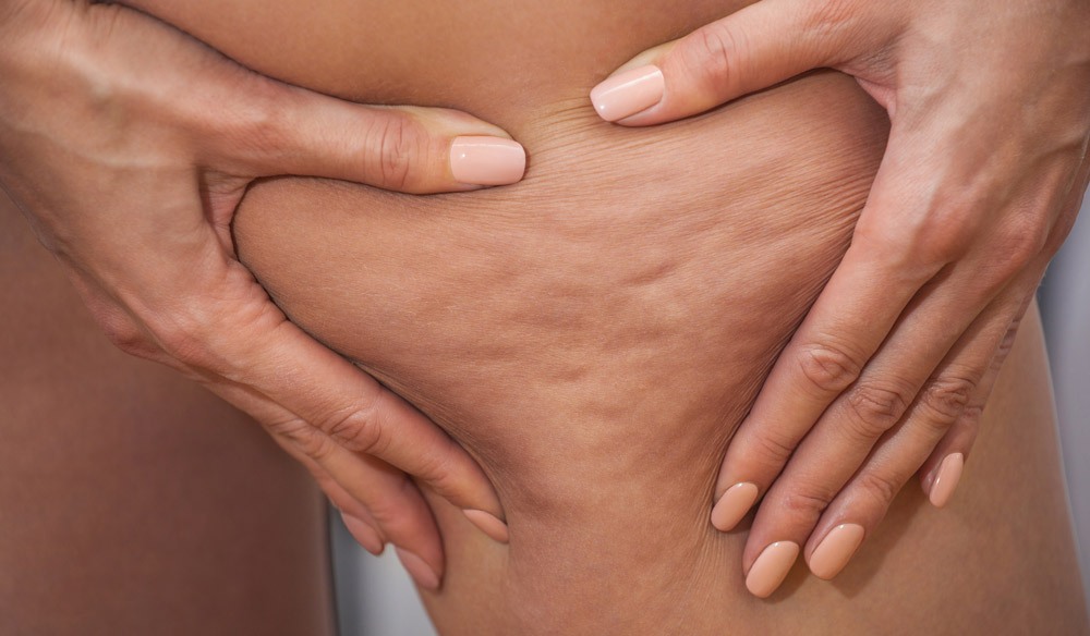 Girl shows holding and pushing the skin of the legs cellulite, orange peel. Treatment and disposal of excess weight, the deposition of subcutaneous fat tissue Girl shows holding and pushing the skin of the legs cellulite, orange peel. Treatment and disposal of excess weight, the deposition of subcutaneous fat tissue