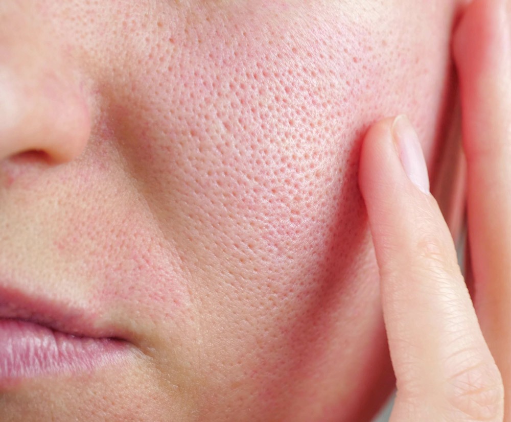 Skin texture with enlarged pores. Part of a woman's face with redness