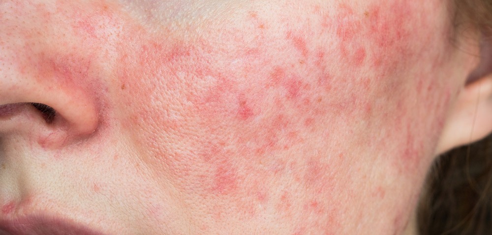 papulopustular rosacea, close-up of the patient's cheek