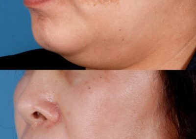 Chemical Peels