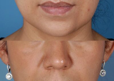 Chemical Peels