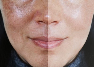 Chemical Peels