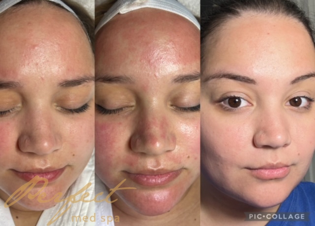 PRP Microneedling Before and After Photo by Perfect Med Spa in New York, NY PRP Microneedling Before and After Photo by Perfect Med Spa in New York, NY