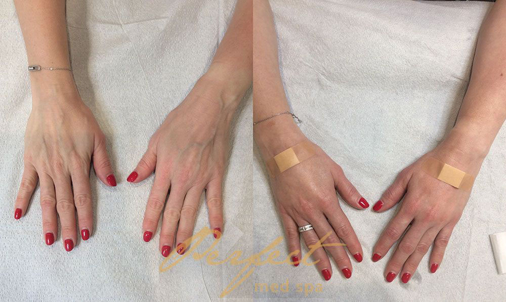 Hands Rejuvenation Before and After Photo by Perfect Med SPA in New York New York