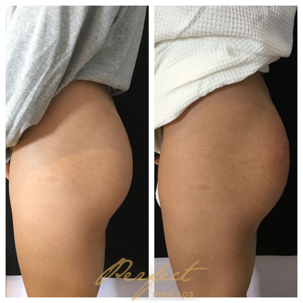 Sculptra for buttocks augmentation Before and After Photo by Perfect Med SPA in New York New York