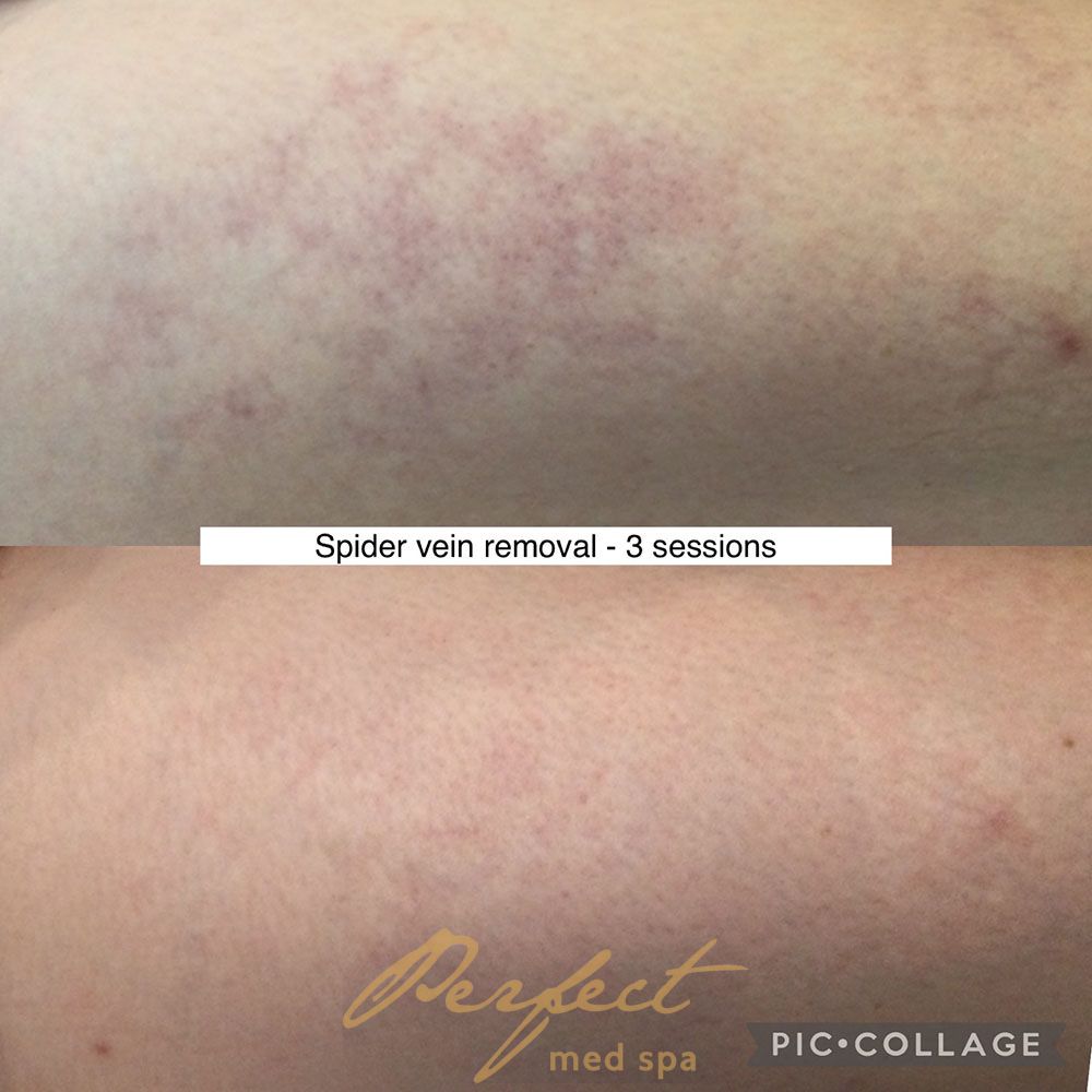 Spider Vein Removal Before and After Photo by Perfect Med SPA in New York New York