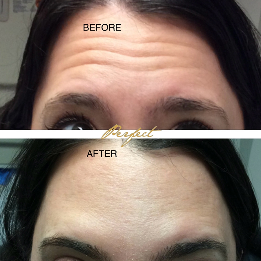 Botox, Dysport Facelift Before and After Photo by Perfect Med Spa in New York City, NY