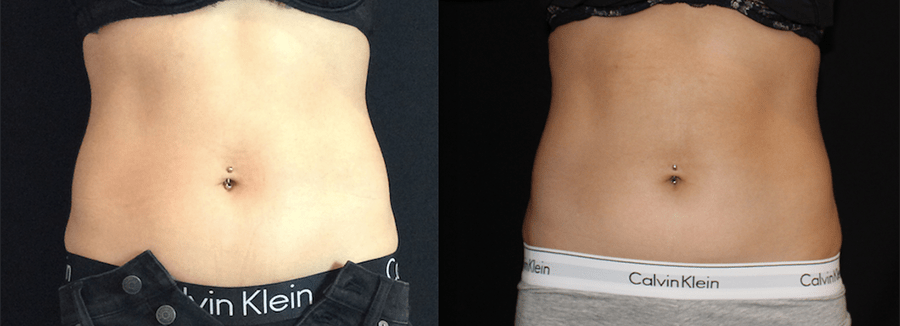 CoolSculpting Before and After Photo by Perfect Med Spa in New York City, NY