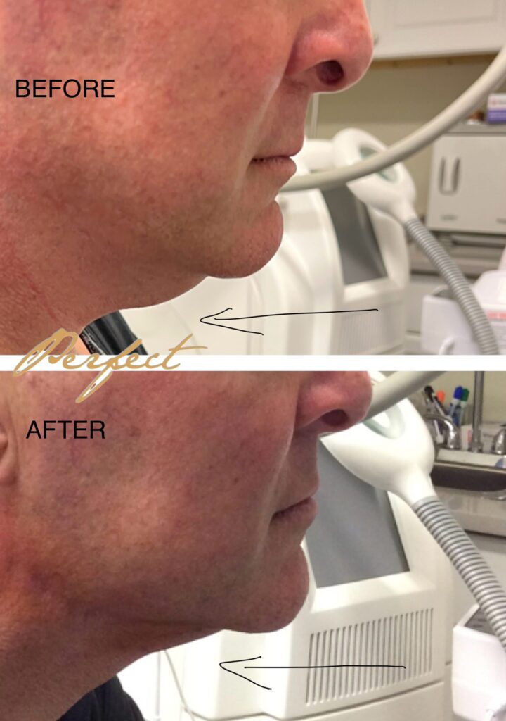 CoolSculpting Before and After Photo by Perfect Med Spa in New York City, NY