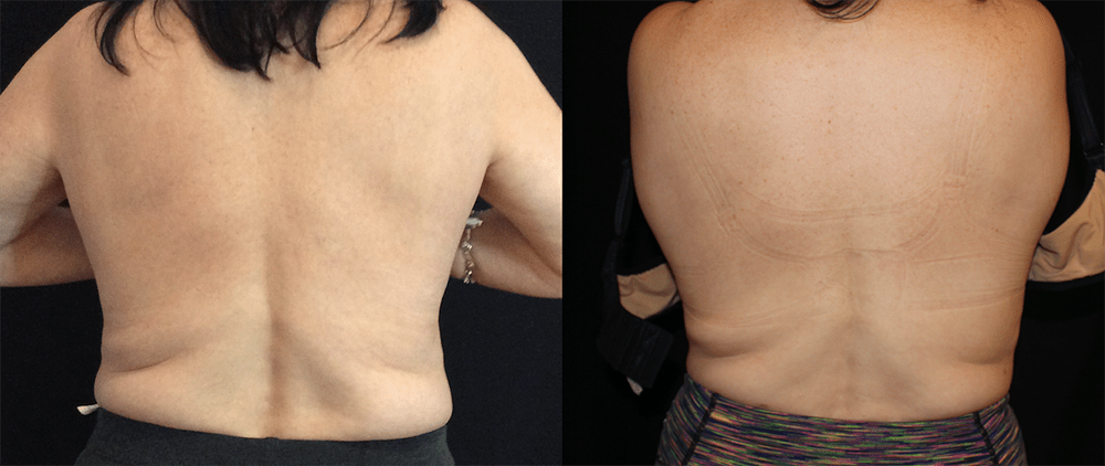CoolSculpting Before and After Photo by Perfect Med Spa in New York City, NY