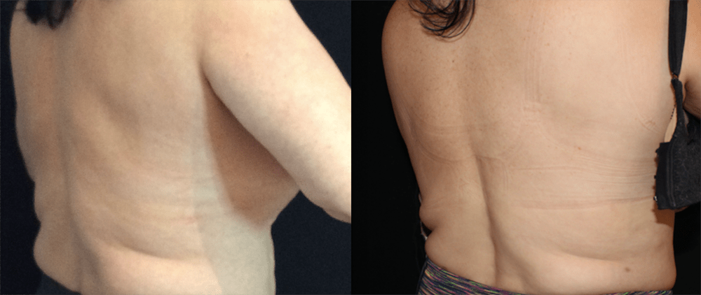 CoolSculpting Before and After Photo by Perfect Med Spa in New York City, NY