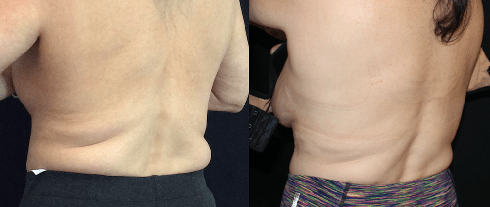 CoolSculpting Before and After Photo by Perfect Med Spa in New York City, NY