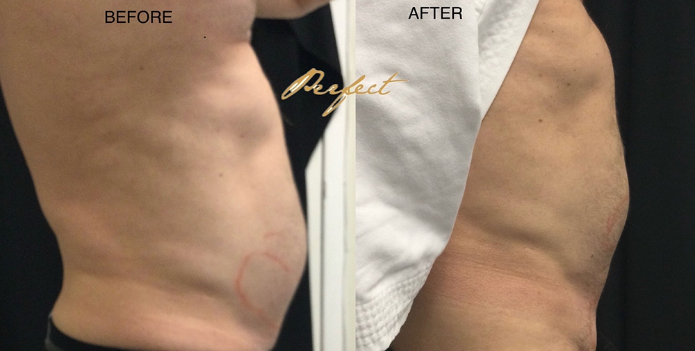 CoolSculpting Before and After Photo by Perfect Med Spa in New York City, NY