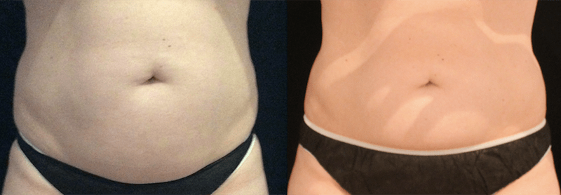CoolSculpting Before and After Photo by Perfect Med Spa in New York City, NY