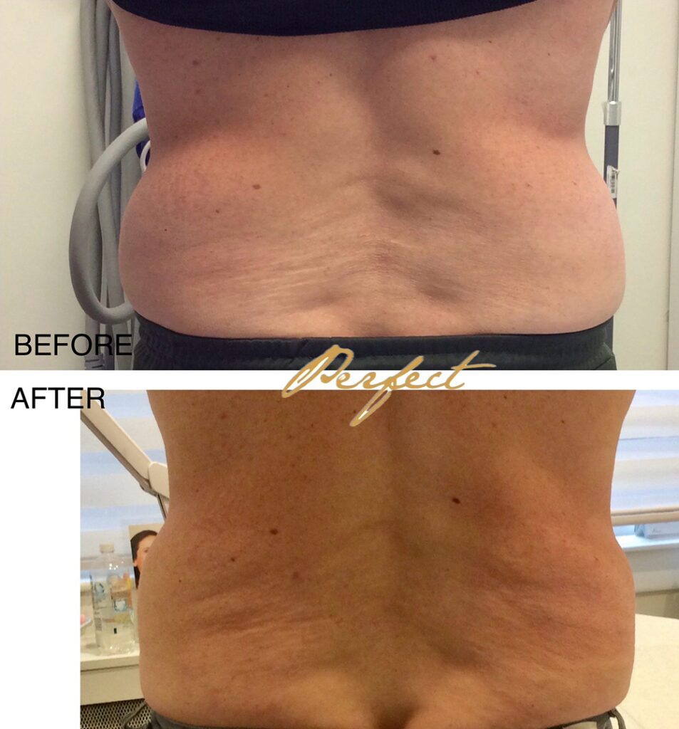 CoolSculpting Before and After Photo by Perfect Med Spa in New York City, NY
